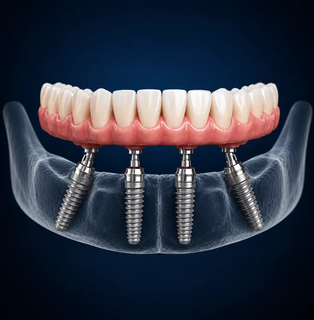 All-on-4 dental implant diagram showing four angled implants