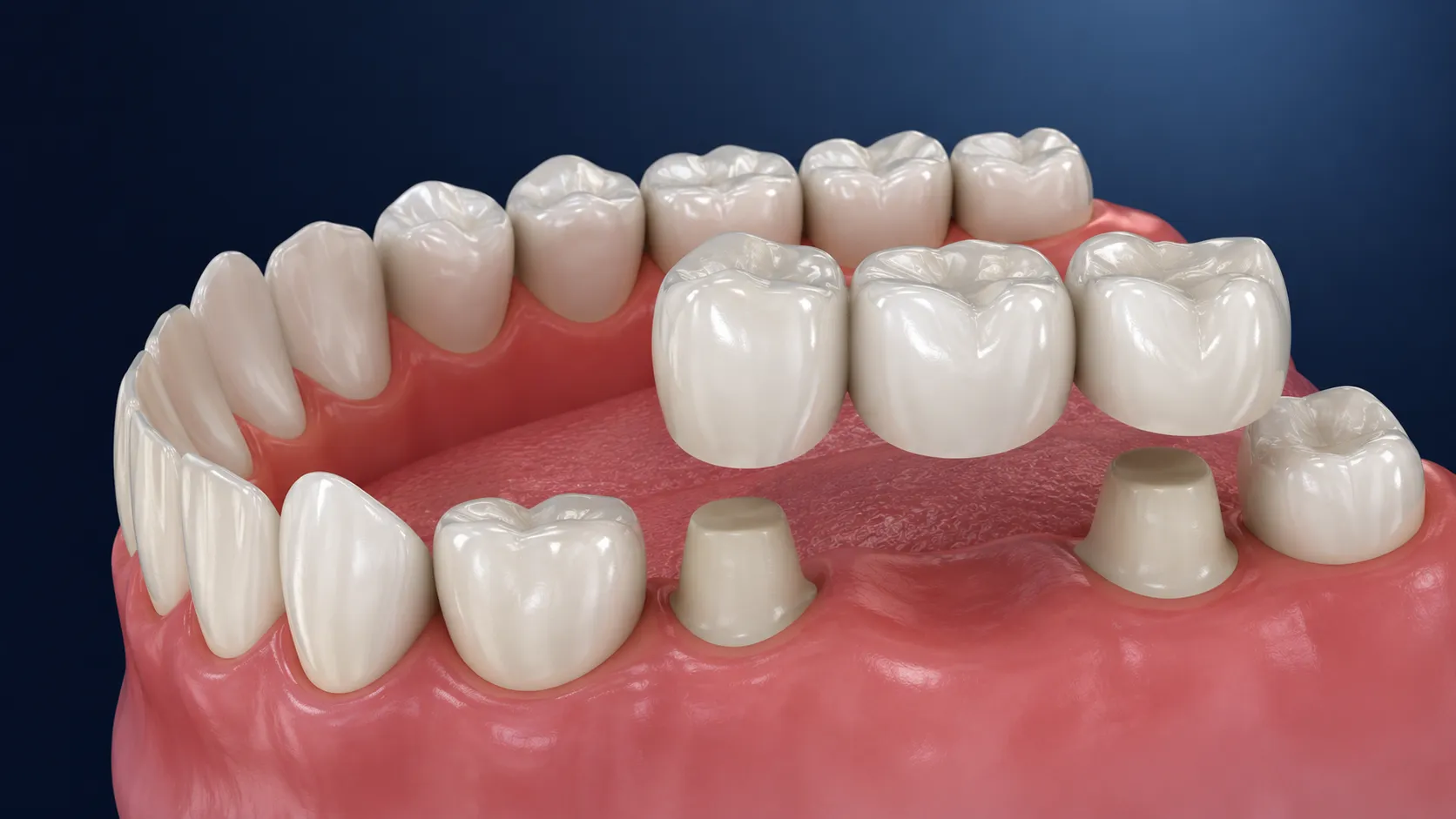 Crowns and bridges dental restoration