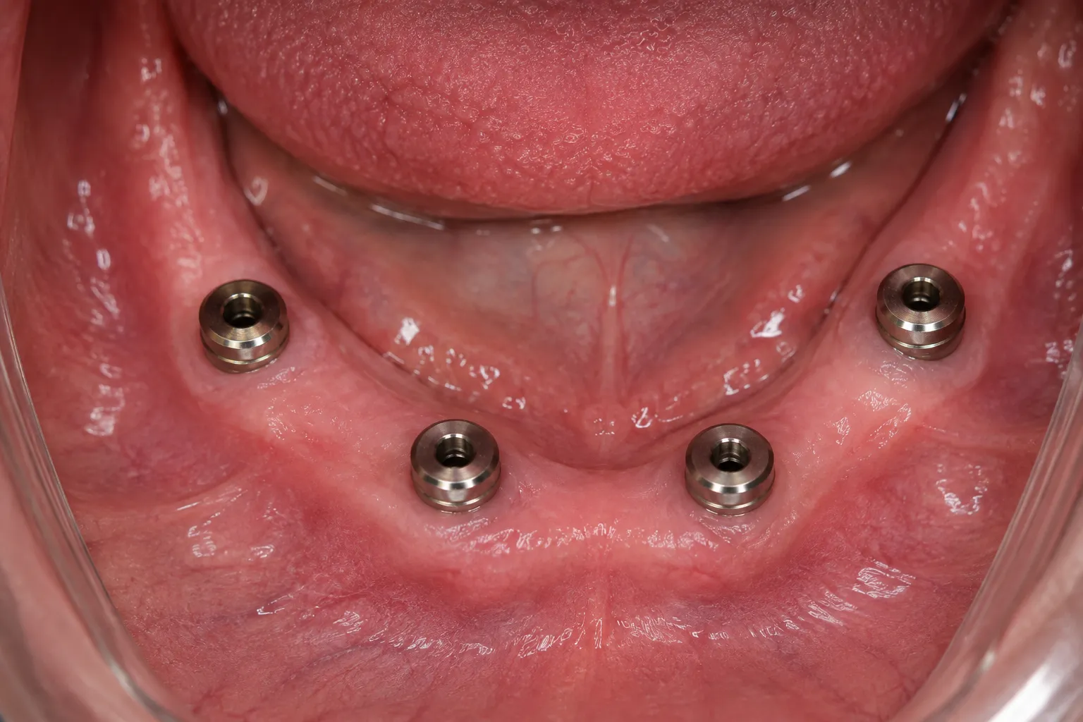 Dental implant healing and follow-up